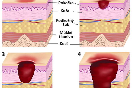 Mikroprúdy v liečbe dekubitov