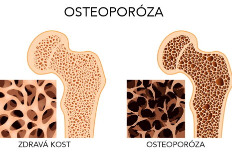 Magnetoterapia - využitie magnetického poľa v liečbe osteoporózy
